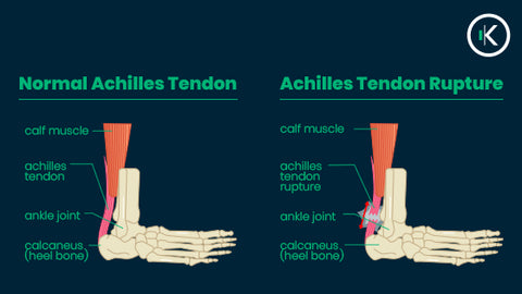 A diagram of the Achilles tendon