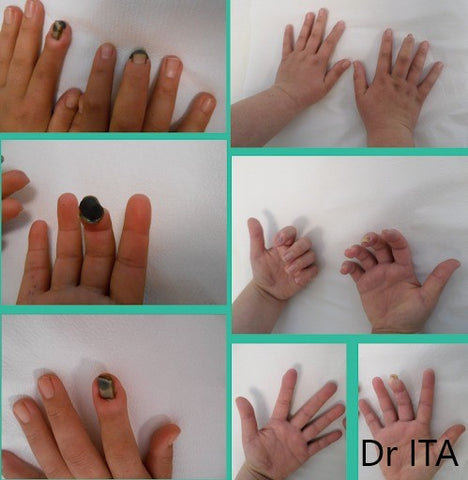 Before and after images of hands with ischemic ulcers treated with NuroKor Lifetech