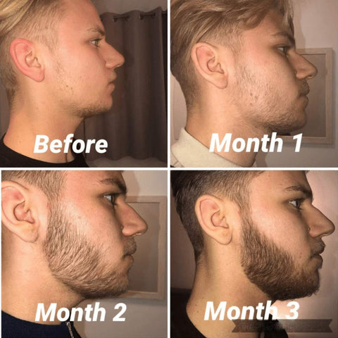 Før og etter resultater med skjeggvekst ruller roller