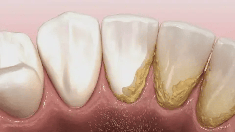 Teeth Cleaner™ Tannsteinfjerner med 5 nivåer