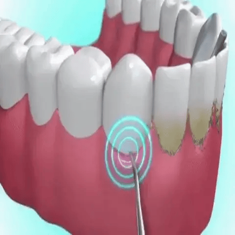 Teeth Cleaner™ Tannsteinfjerner med 5 nivåer