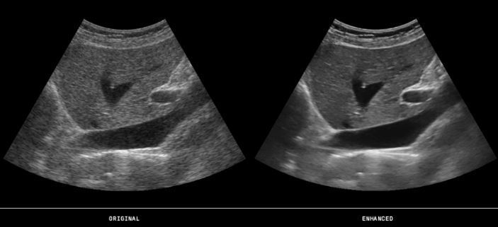 Ultrasounds Made Easy Part II: Speckle Reduction Imaging
