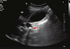 Abdominal ultrasound showing stones