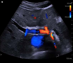 Doppler ultrasound