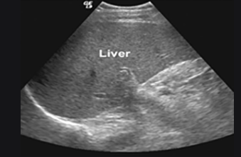 Liver ultrasound