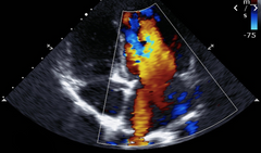 Cardiac ultrasound image