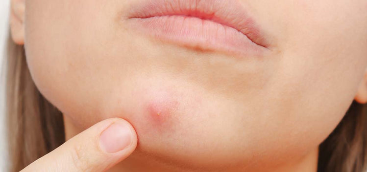 how-to-get-rid-of-pesky-blind-pimples-the-easy-way