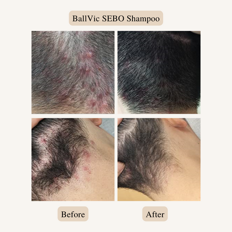 Say goodbye to greasy, oily hair with our sebo shampoo! Formulated with natural ingredients like tea tree oil and aloe vera, this shampoo helps to control excess oil production and soothe irritated scalps. Use it regularly to maintain healthy, balanced hair and scalp.