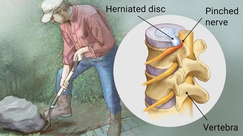 diagram of herniated disc