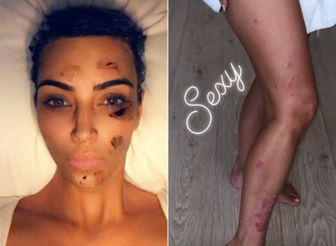 Kim Kardashian with Psoriasis - Auto-Immune Disorder - Skin redness - celebrity with skin disorder