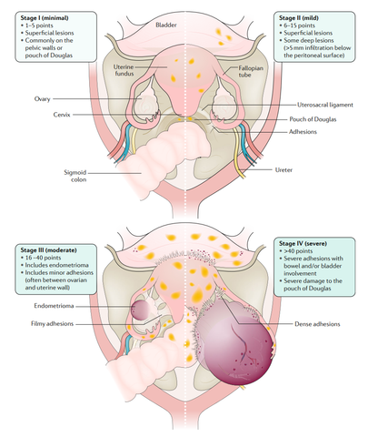 Image showing endometriosis "stages"