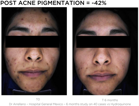 Bright Serum - Post Acne Pigmentation