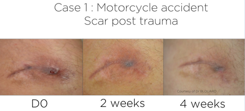  Regen Hx Motorcycle accident Scar post trauma