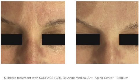 Surface CR Cream Treatment