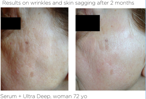 Ultra Deep - Results on wrinkles and skin sagging after 2 months
