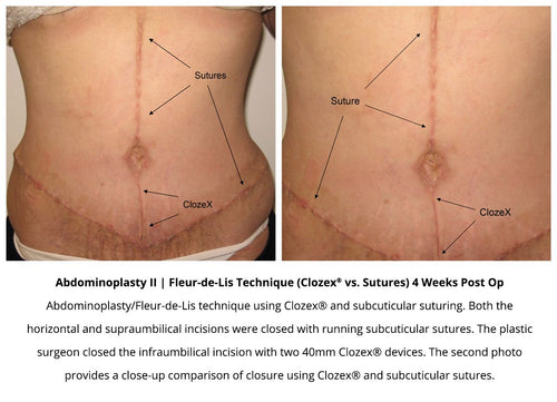 Fleur de Lis Abdominoplasty - iMed Medical