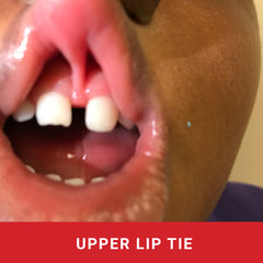 Child's mouth showing upper lip tie