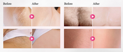 brazilian laser hair removal cost