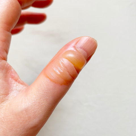 Home Remedies for burns and Blister Treatment