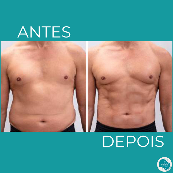 Antes e depois da abdominoplastia: fotos