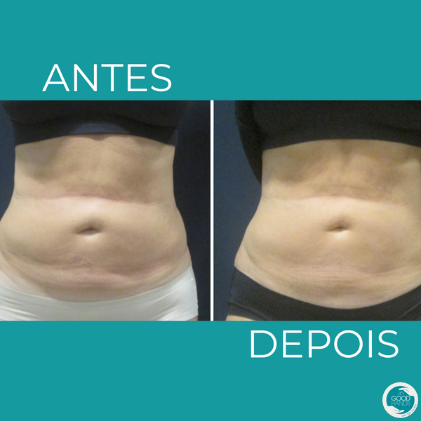 Antes e depois da abdominoplastia: fotos