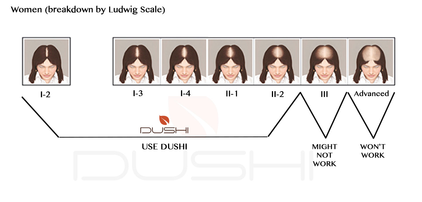 Ludwig's Scale for Women - Use Ludwigs Scale Chart For Hair Loss