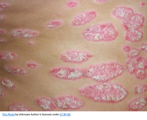 Close-up of Psoriasis on the skin