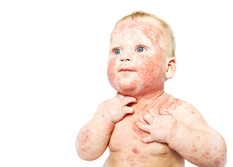 Photo d'un bébé atteint d'ECZÉMA dans "L'ECZÉMA EST-IL HÉRÉDITAIRE ? UNE ÉTUDE SCIENCE SOUTENUE"