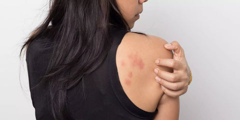 Lady with skin rash