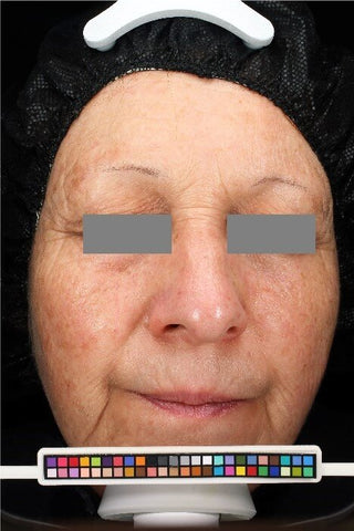 woman with rosacea after picture