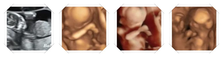 15.2 week 3D ultrasound image scans of twins