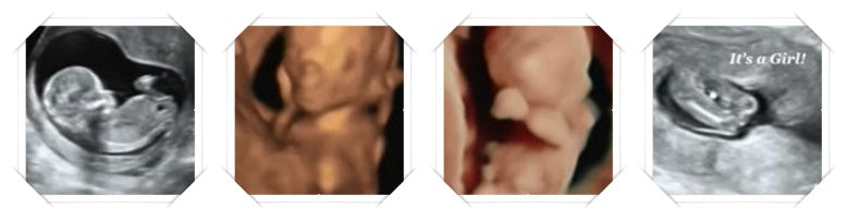 15 week 3D ultrasound image scans