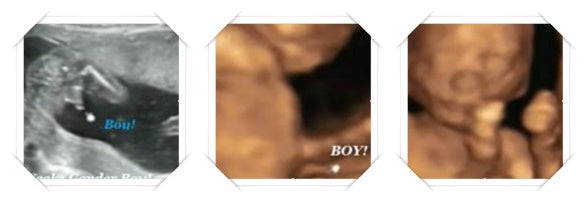 18 week ultrasound image scans