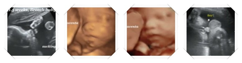 31 week ultrasound image scans with placenta