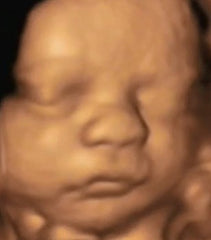 Prenatal Ultrasound Image of Baby