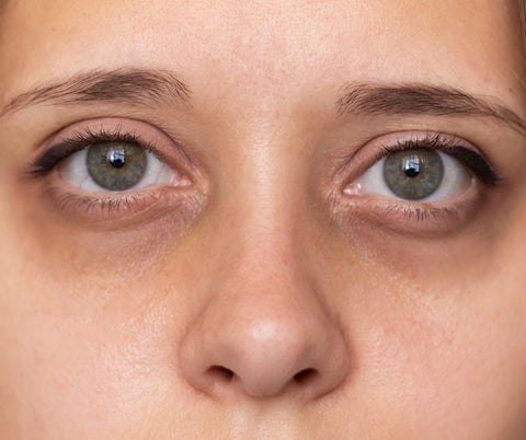 dark circles under eyes