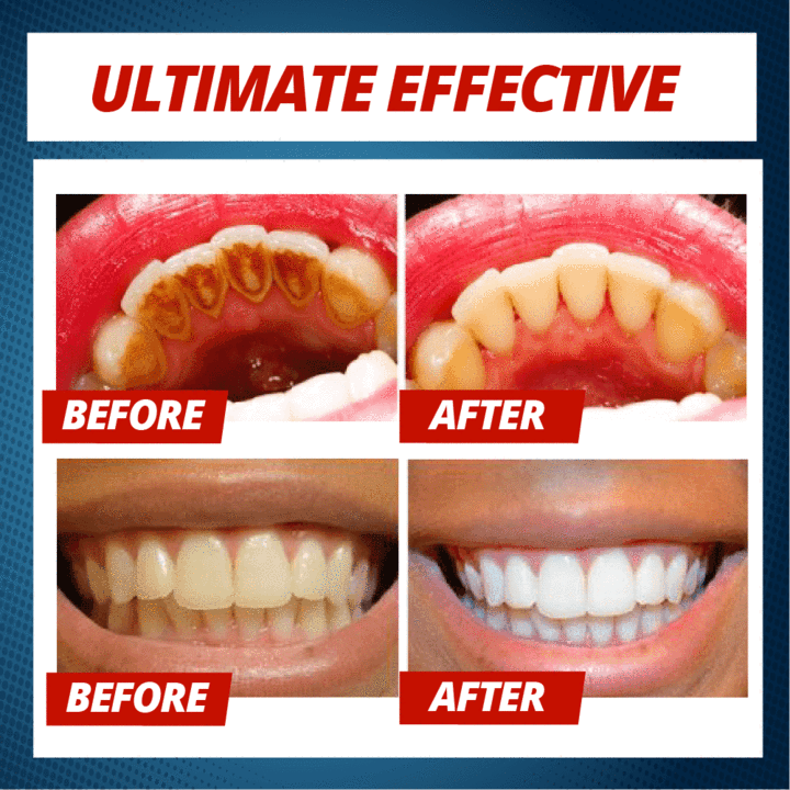 (BUY 2 ONLY $33.49)Intensive Stain Removal Whitening Toothpaste--Non-toxic, Safe, Chemical-free