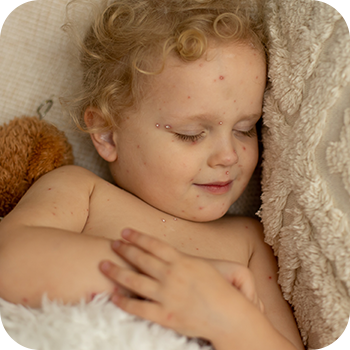 hydration-and-rest-chicken-pox-management