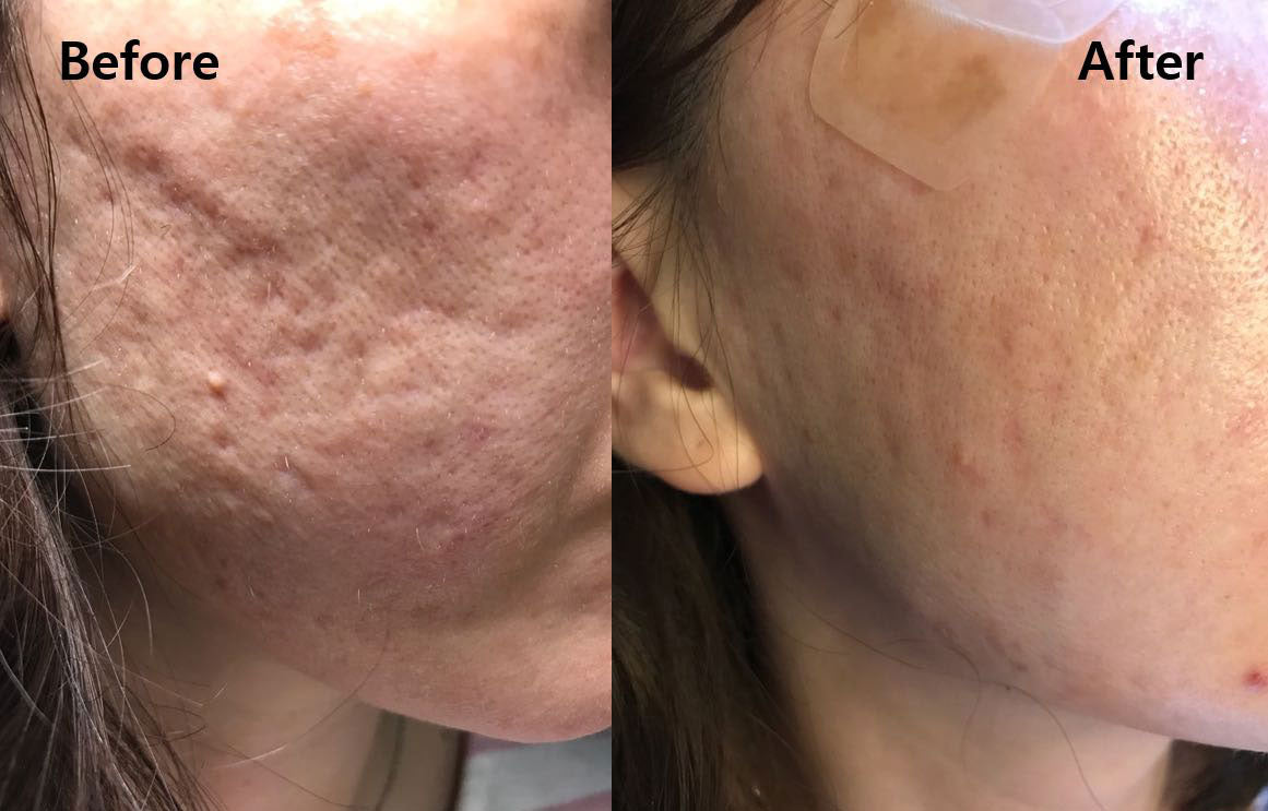 Microcurrent Facial Before & After Results Microcurrent Facial Mask Treatment