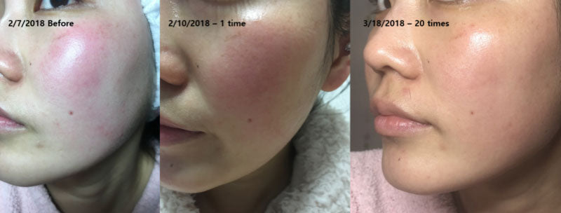 Before & After Results from a Franz Microcurrent Facial Mask Treatment