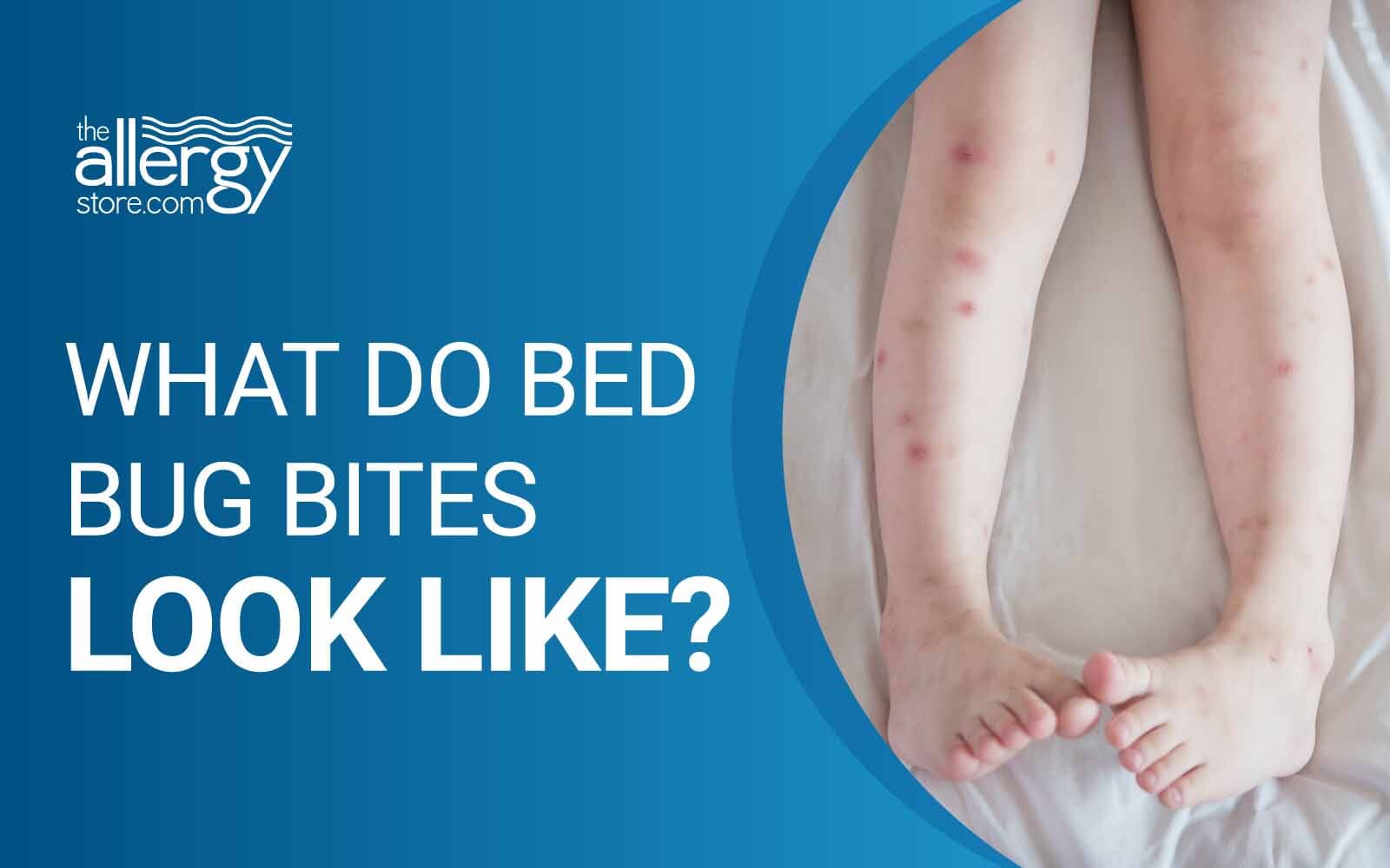 do-bed-bug-bites-go-away-pest-phobia