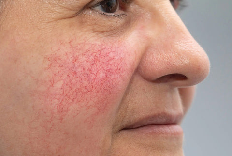 Rosacea and Redness