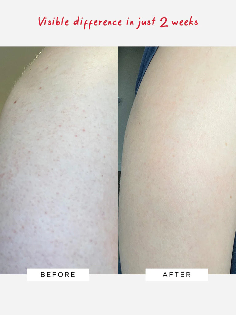 Dr Sam's Flawless Body Therapy AHA Body Lotion Before and After Image