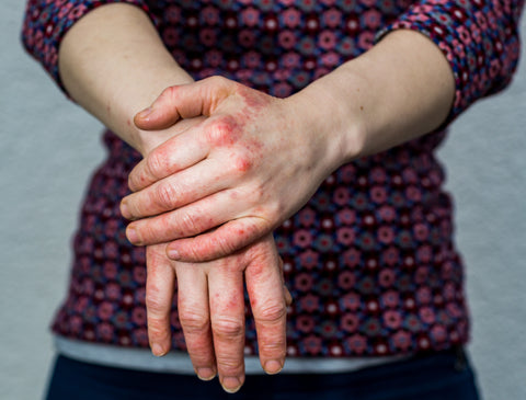 first picture of eczema on hands