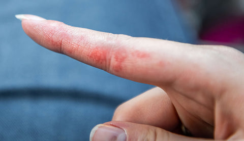 second picture of eczema on hands