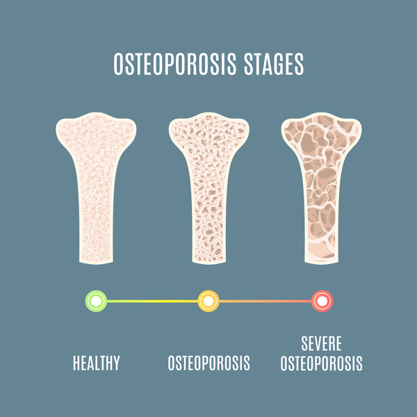 Osteoporosis Bones - InterPlexus Musculoskeletal Support Category