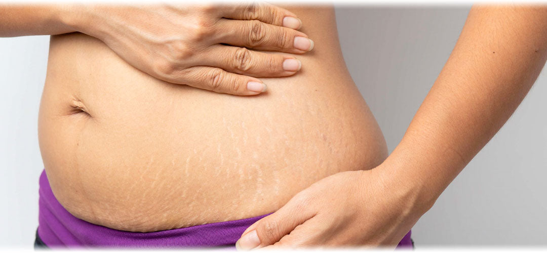 An image displaying the text 'Stretch Mark Header 2021' against a background of skincare products and stretch mark lines. The image suggests the topic of managing stretch marks