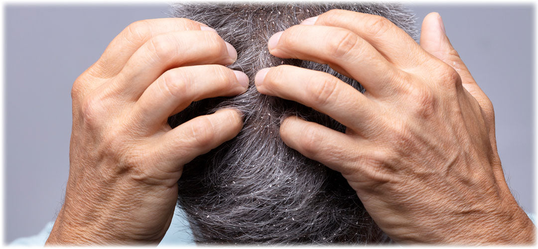 Middle age male inspecting scalp for dandruff.