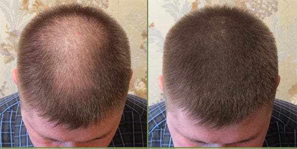 How Men And Women Use Hair Powders To Cover Balding Best Tape