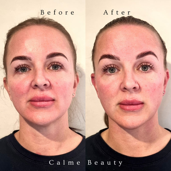 Before and after photo of woman's face after a Face Sculpting Massage | Adashiko Collagen